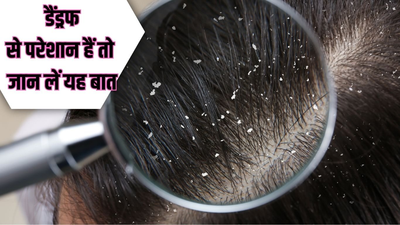dandruff से परेशान हैं तो जान लें यह बात