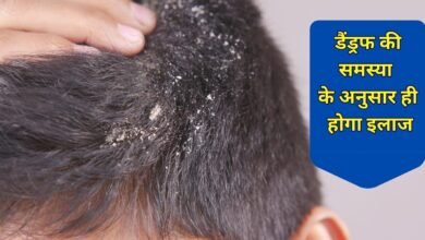 dandruff से परेशान हैं तो जान लें यह बात